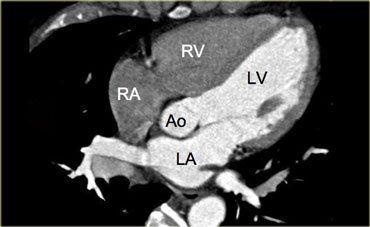 5-chamber view. RA=right atrium, RV=right ventricle, Ao=aorta, LA=left atrium, LV=left ventricle