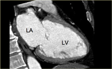 2-chamber view. LA=left atrium, LV=left ventricle