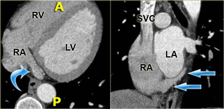 Axial (left) and coronal oblique (right) reconstructions showing the coronary sinus as it enters the right atrium (blue arrows). A=anterior, P=posterior