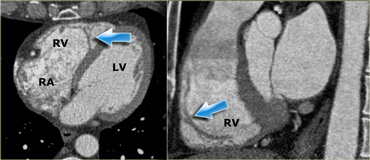 Axial (left) and sagittal oblique (right) reconstructions showing the right ventricle. The blue arrows indicate the moderator band. RA=right atrium, RV=right ventricle, LV=left ventricle