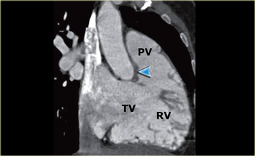 Reconstruction showing the tricuspid (TV) and pulmonary (PV) valves as well as the cavity of the right ventricle (RV). The blue arrow indicates the crista supraventricularis