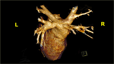 3D-reconstructions showing the pulmonary veins as they enter the left atrium
