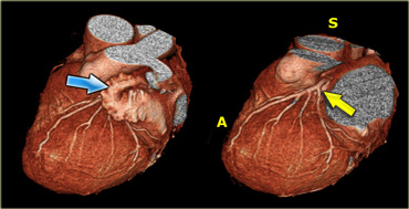 3D-reconstructions showing the left atrial appendage (blue arrow) and the left coronary artery (yellow arrow) after the left atrial appendage has been removed. A=anterior, S=superior).)