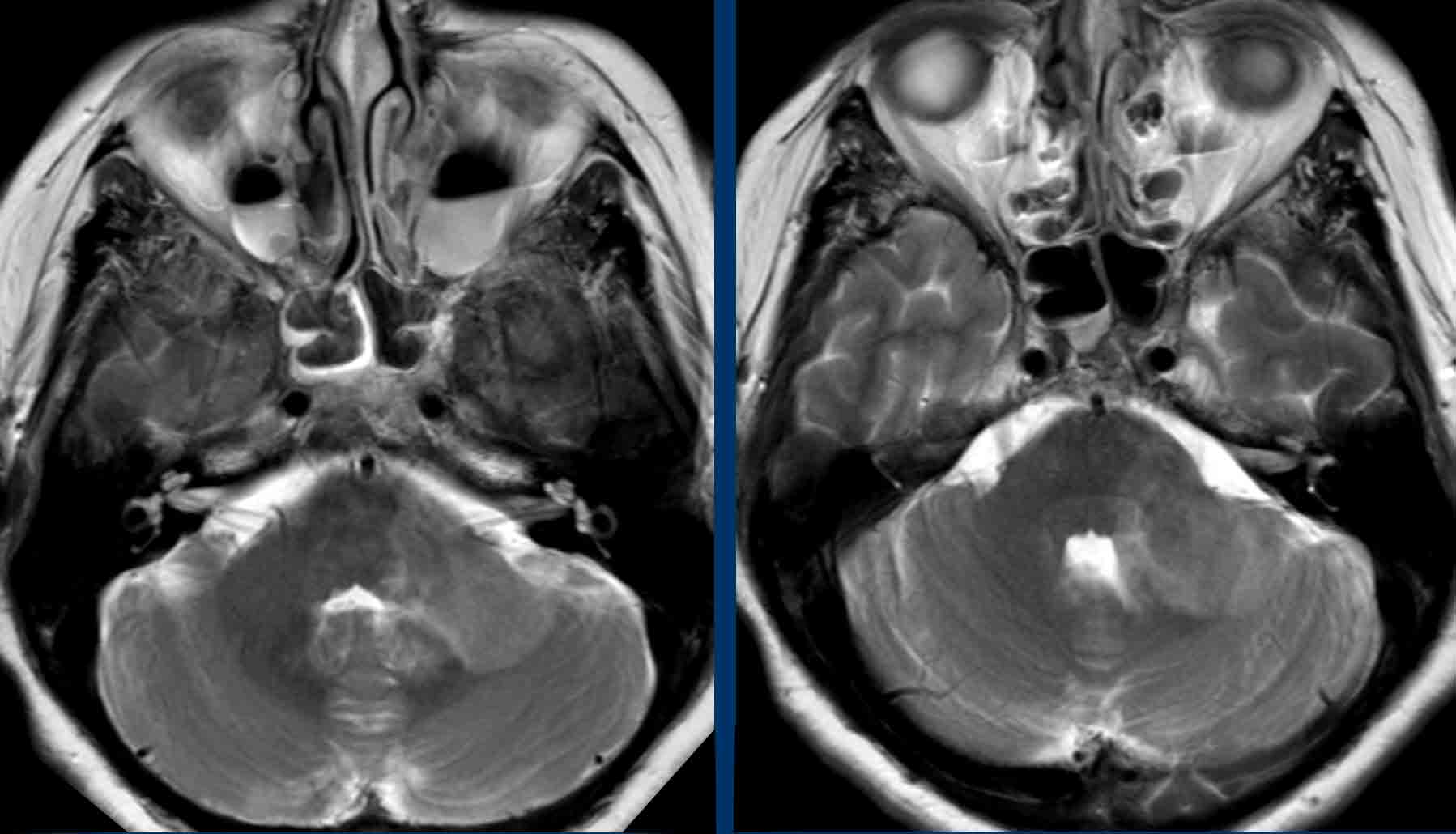 The Radiology Assistant Horner Syndrome 6822