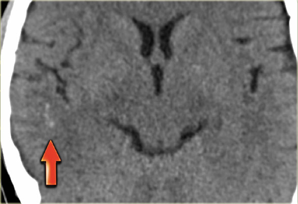 Dense clot sign in a thrombosed cortical vein.