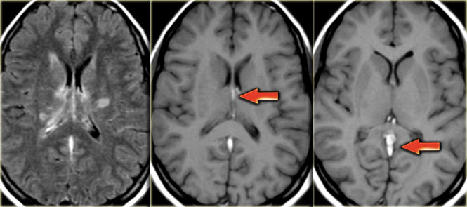 Bilateral infarctions in the basal ganglia due to deep cerebral venous thrombosis