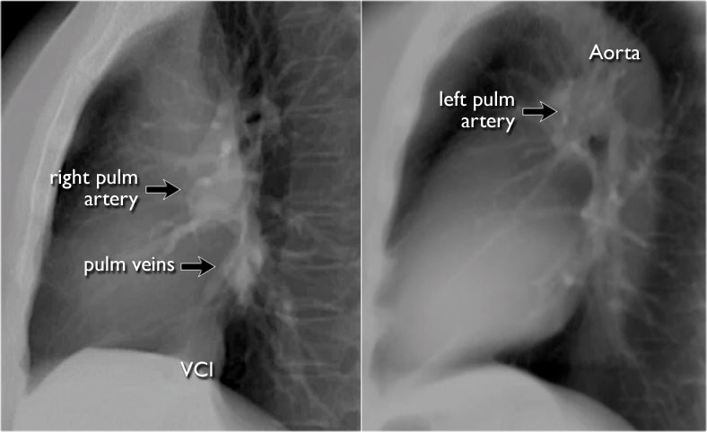 normal chest xray labeled