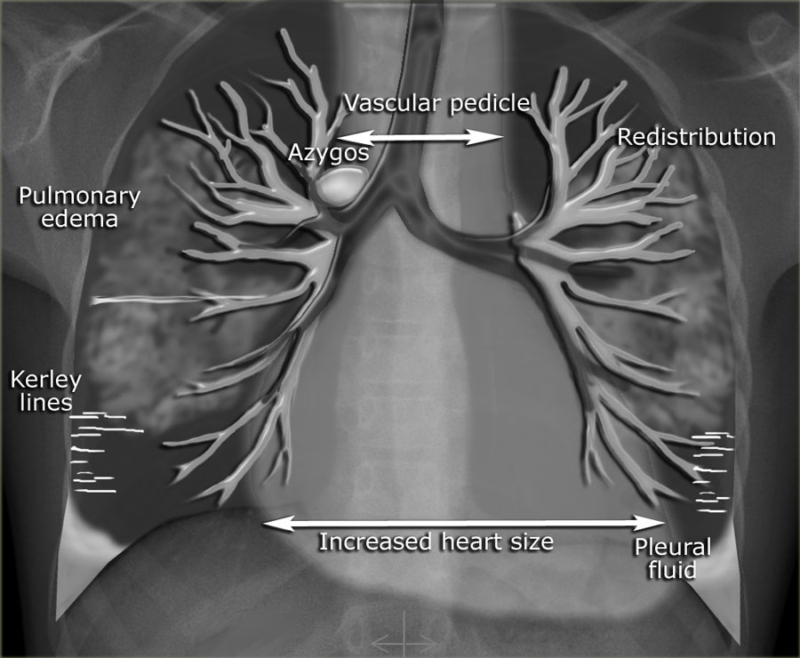 The Radiology Assistant : Chest X-Ray - Heart Failure