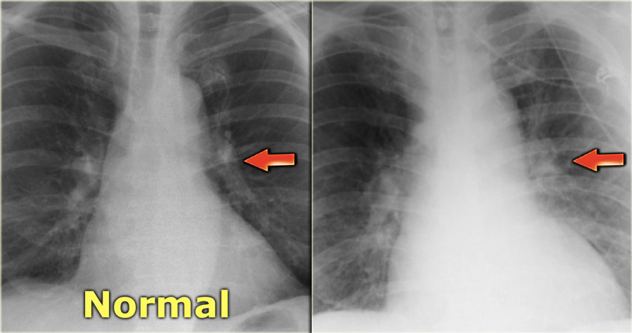 The Radiology Assistant Heart Failure