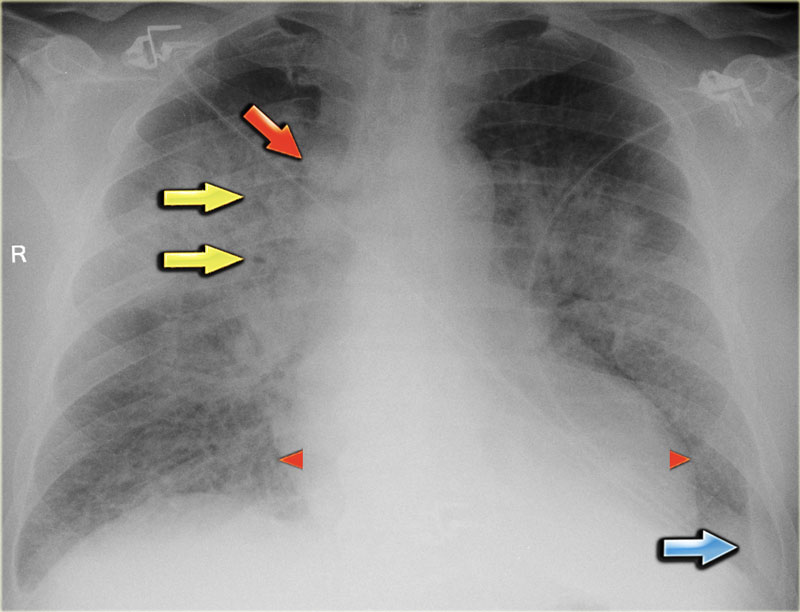 The Radiology Assistant : Chest X-Ray - Heart Failure