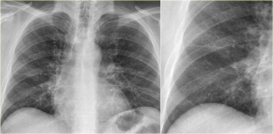 The Radiology Assistant : Chest X-Ray - Lung Disease