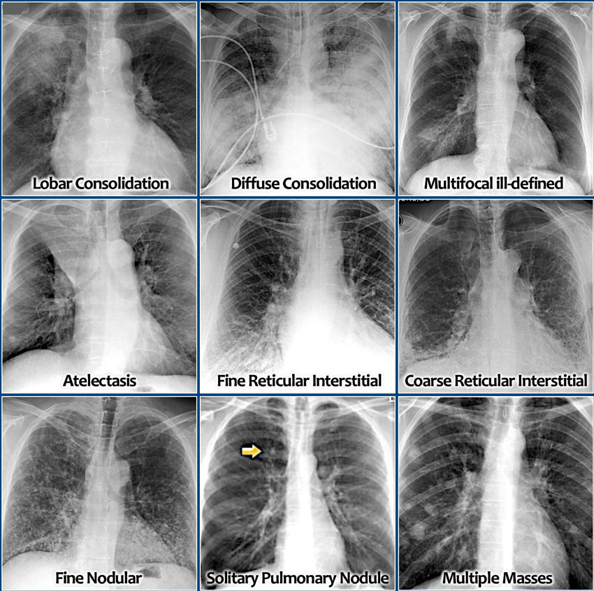 The Radiology Assistant Chest X Ray Lung Disease