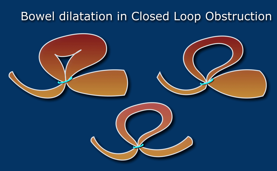 The Radiology Assistant Closed Loop Obstruction with video