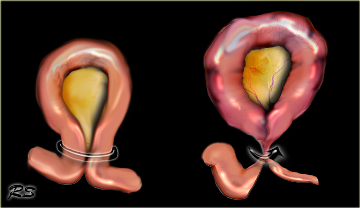 The Radiology Assistant Closed Loop Obstruction In Small Bowel   A5097977679e3f TEK Bowel Ischemia 2 