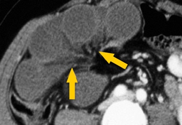 Closed loop obstruction with bowel ischemia
