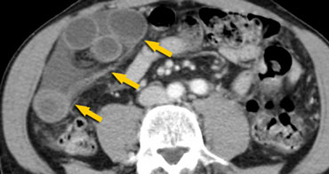 Closed loop obstruction presenting as a clump of bowel loops