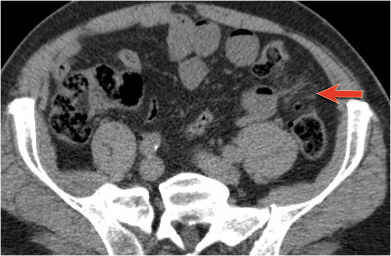 The Radiology Assistant : Closed Loop Obstruction in Small bowel ...