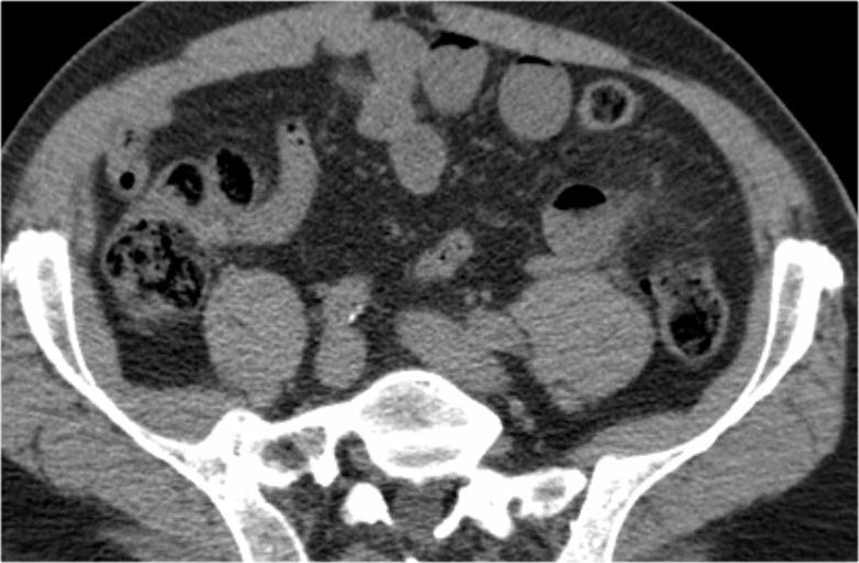 The Radiology Assistant Closed Loop Obstruction In Small Bowel Obstruction 9811