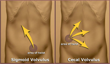 Cecal volvulus can go almost anywhere