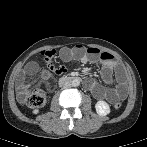 The Radiology Assistant Closed Loop Obstruction In Small Bowel Obstruction 6073