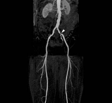 Patient with intermittend claudication on the left and an isolated stenosis in the left iliac artery.
