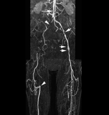 Patient with chronic critical ischemia and 'multi level' disease.