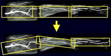 Sagittal MIP of TOF-series from aorta to the level of the feet. Variation in width and angulation will result in a better coverage at the different levels.