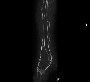 Dedicated imaging of crural arteries and pedal arch in patient with critical ischemia.