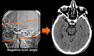 CT with negative scan angle for optimal vizualisation of the hippocampus in the transverse plane