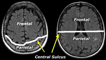The central sulcus is more posteriorly on more cranial images.