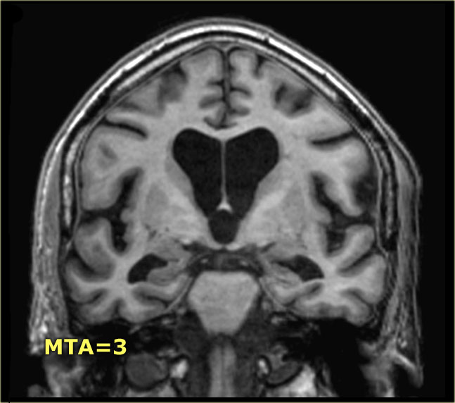 Dementia MRI Scan