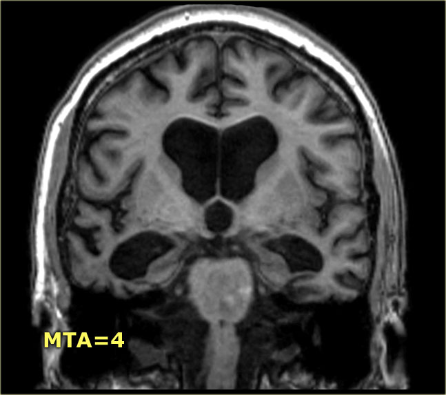 Dementia Brain Mri White Spots