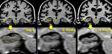Coronal T1WI of the hippocampus  demonstrating progressive atrophy in familial AD (images kindly provided by Nick Fox).