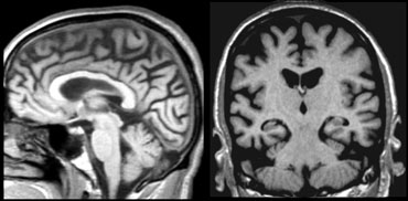 Presenile AD with normal hippocampus and severe parietal atrophy.