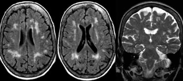Vascular dementia, no medial temporal lobe atrophy.