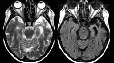 FTLD: T2WI and FLAIR with 'knife blade' atrophy of left temporal lobe with normal right temporal lobe