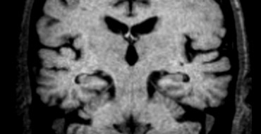Lewi body dementia: normal hippocampus