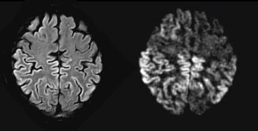 Changes in the neocortex as seen on FLAIR (left) and DWI (right)