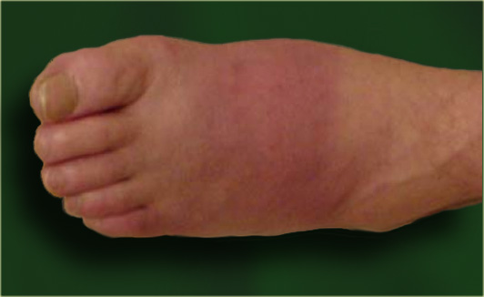 A hot red foot in acute Charcot neuro-osteoarthropathy