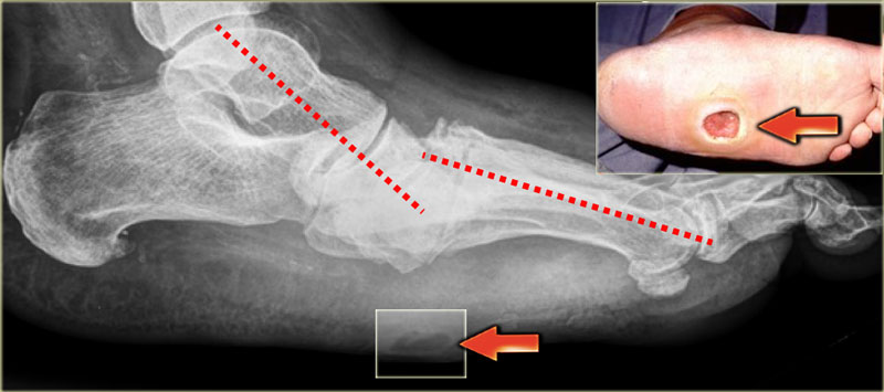 The Radiology Assistant : Diabetic foot - MRI examination