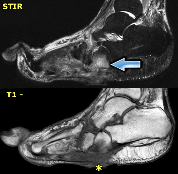STIR and T1W images in Charcot neuro-osteoarthropathy with a plantar ulcer (asterix) and osteomyelitis of the cuboid.