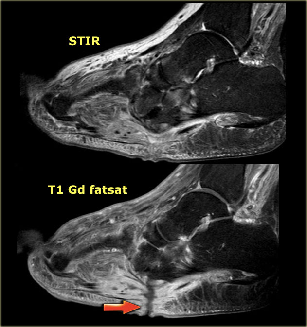 No osteomyelitis in chronic Charcot neuro-osteoarthropathy