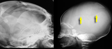 LEFT: eggshell fractures in a child who died of cerebral injury after being thrown from a height.   RIGHT: skull fracture in abused child
