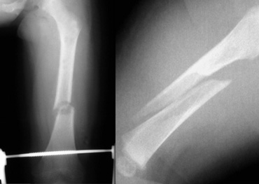 Two infants with a femur fracture. Child abuse was suspected because of the age of the child and an inconsistent history given by the parents.