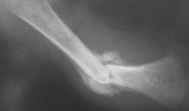 Diaphyseal femur fracture with a lot of callus is at least 2 weeks old.