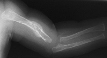 Osteopenia and fracture in a child with osteogenesis imperfecta.