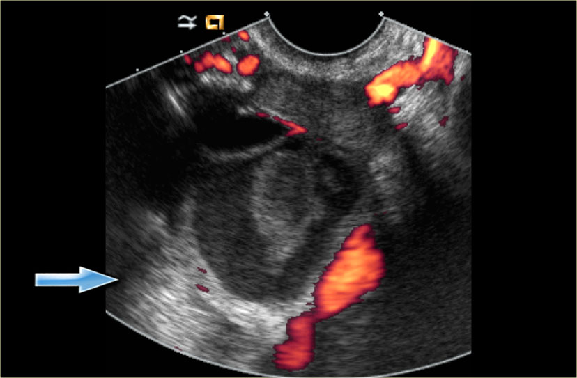 Hemorrhagic Cyst On Ultrasound