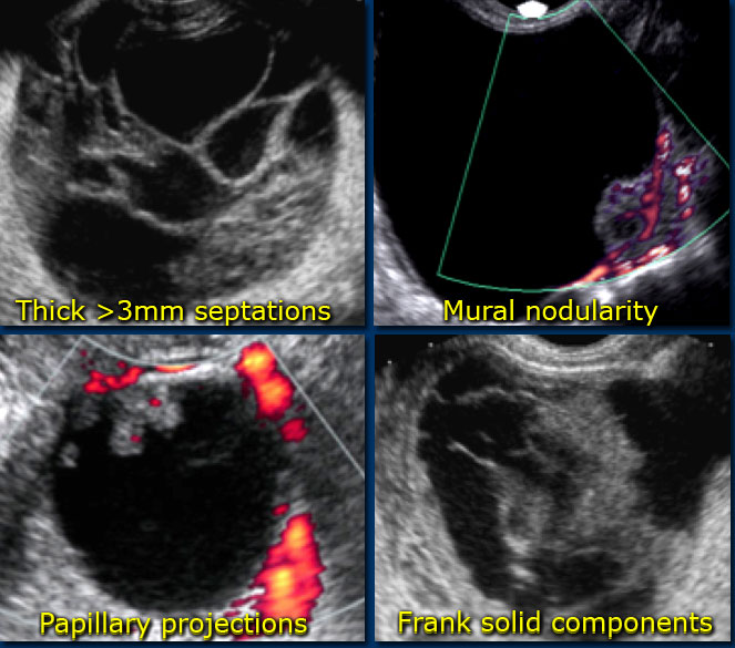 ovarian cancer or cysts