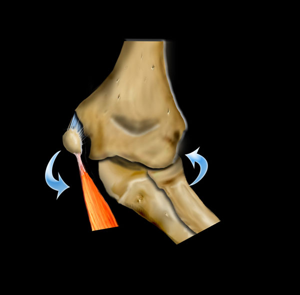 olecranon avulsion fracture