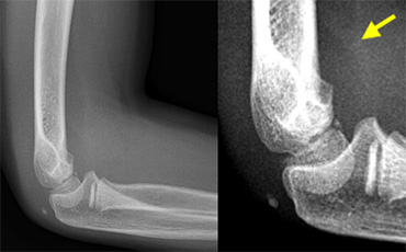 Positive Anterior Fat Pad sign. On digital radiographs you may need to adjust the window width and level to appreciate this. No fracture was visible on the X-rays.